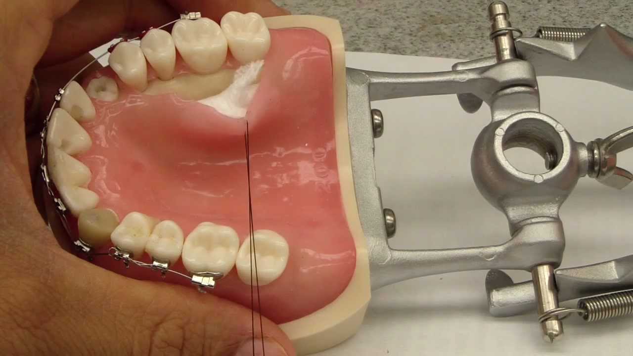 Palatal Flap Elevation Assistance - Connective tissue graft/Crown Lengthening