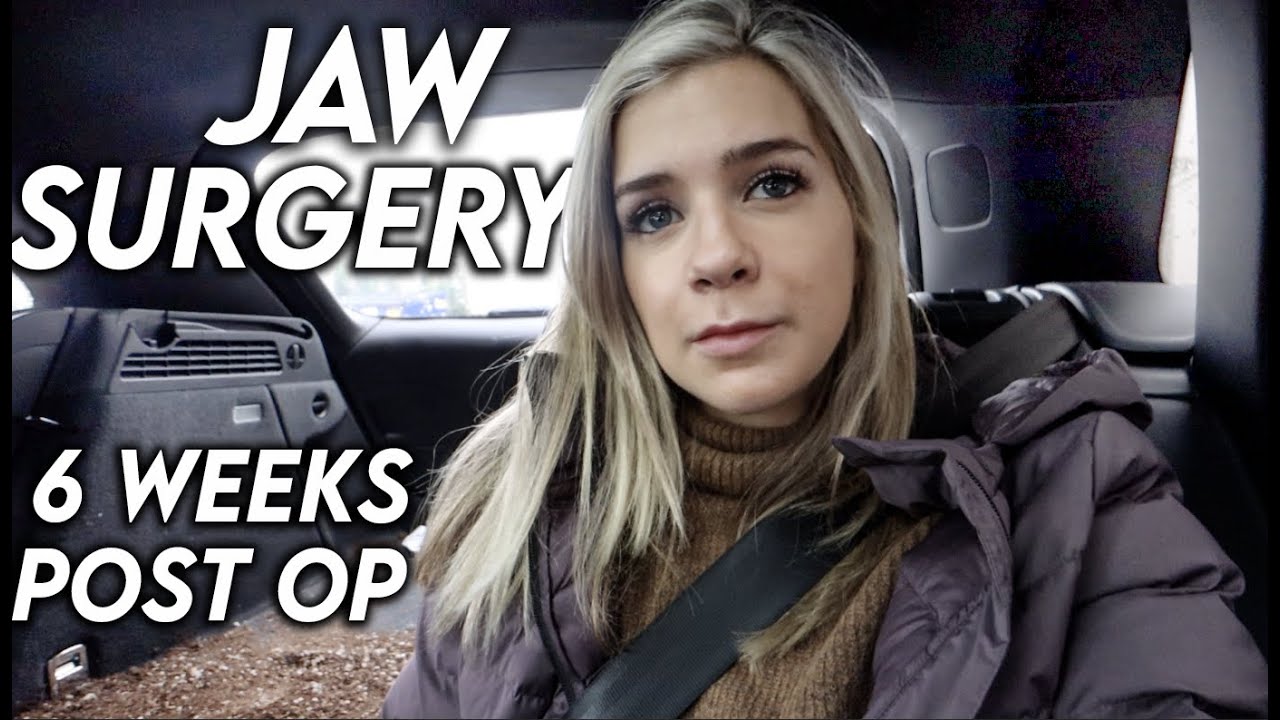 Jaw Surgery... 6 weeks later: Finally looking like myself again