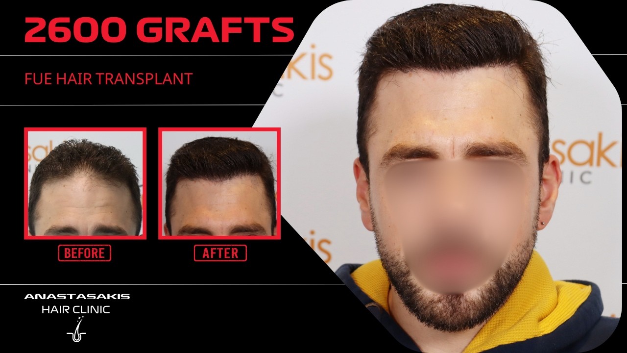 🔥 12 μήνες μετά: νέο hairline & εντυπωσιακή πυκνότητα με 2600 τριχοθυλάκια FUE ✨ case 