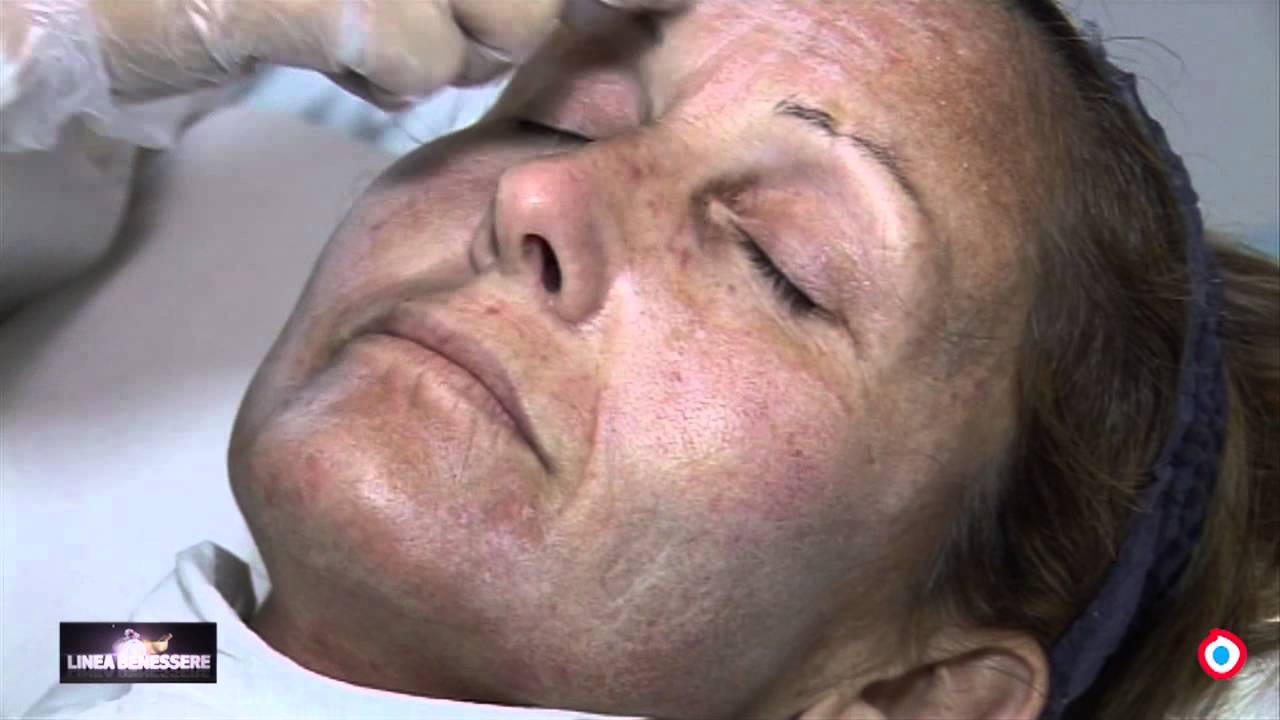 Ore 17.00-OCCHIOTV: oggi parliamo del peeling chimico.
