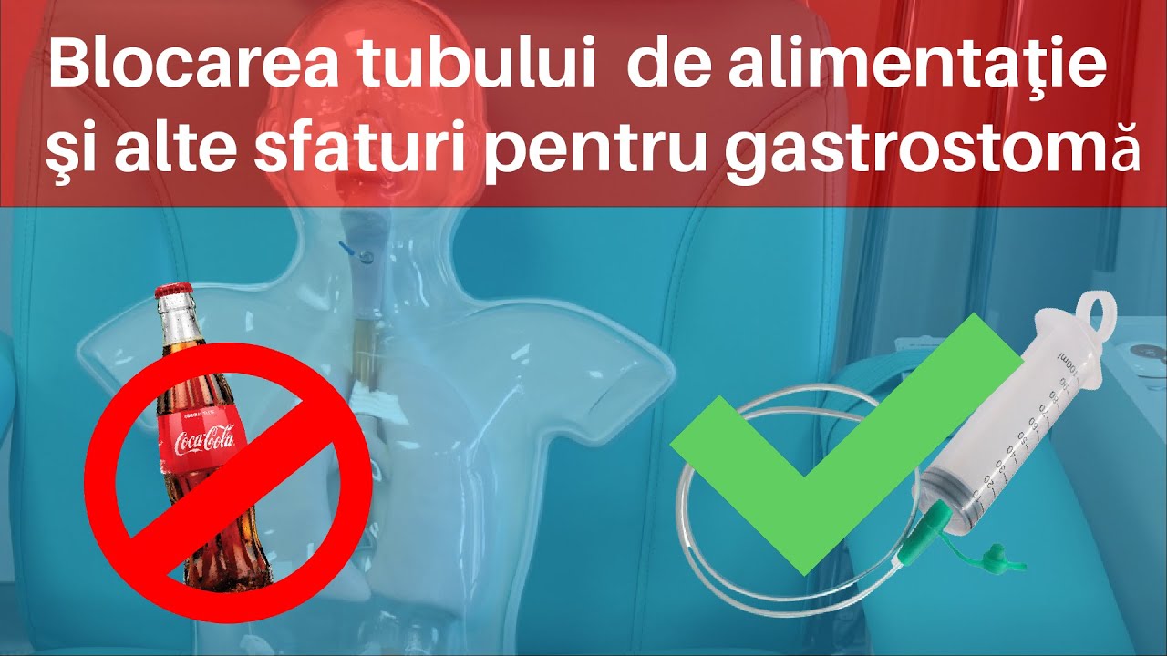 Ce facem dacă s-a blocat tubul de alimentaţie şi alte sfaturi pentru gastrostomă