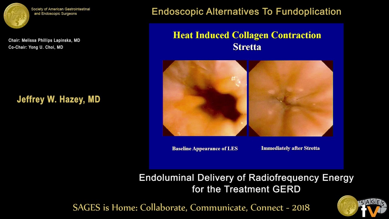Stretta: Endoluminal delivery of radiofrequency energy for the treatment of GERD