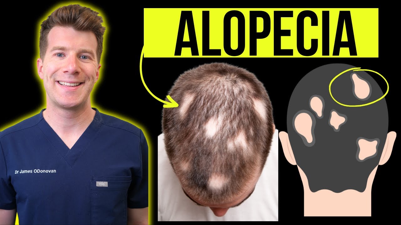 Doctor explains Alopecia Areata (aka patchy or total hair loss) - Signs, Symptoms, Treatment & more