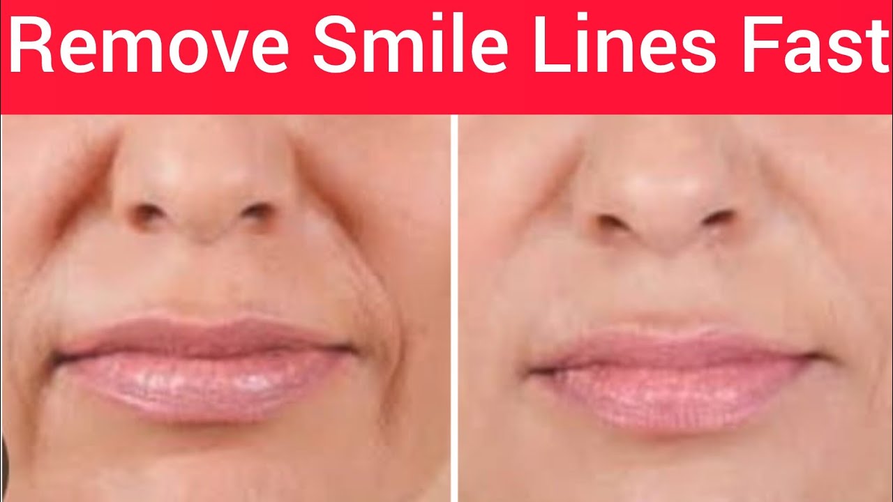 Remove Nasolabial Folds & Marionette Lines | Tighten Sagging around Mouth | Natural Tips