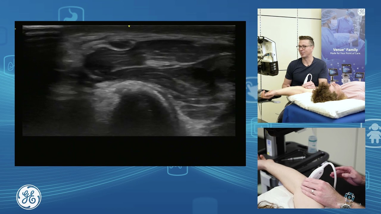 Sonographic assessment of the CFO, UCL and Ulnar nerve
