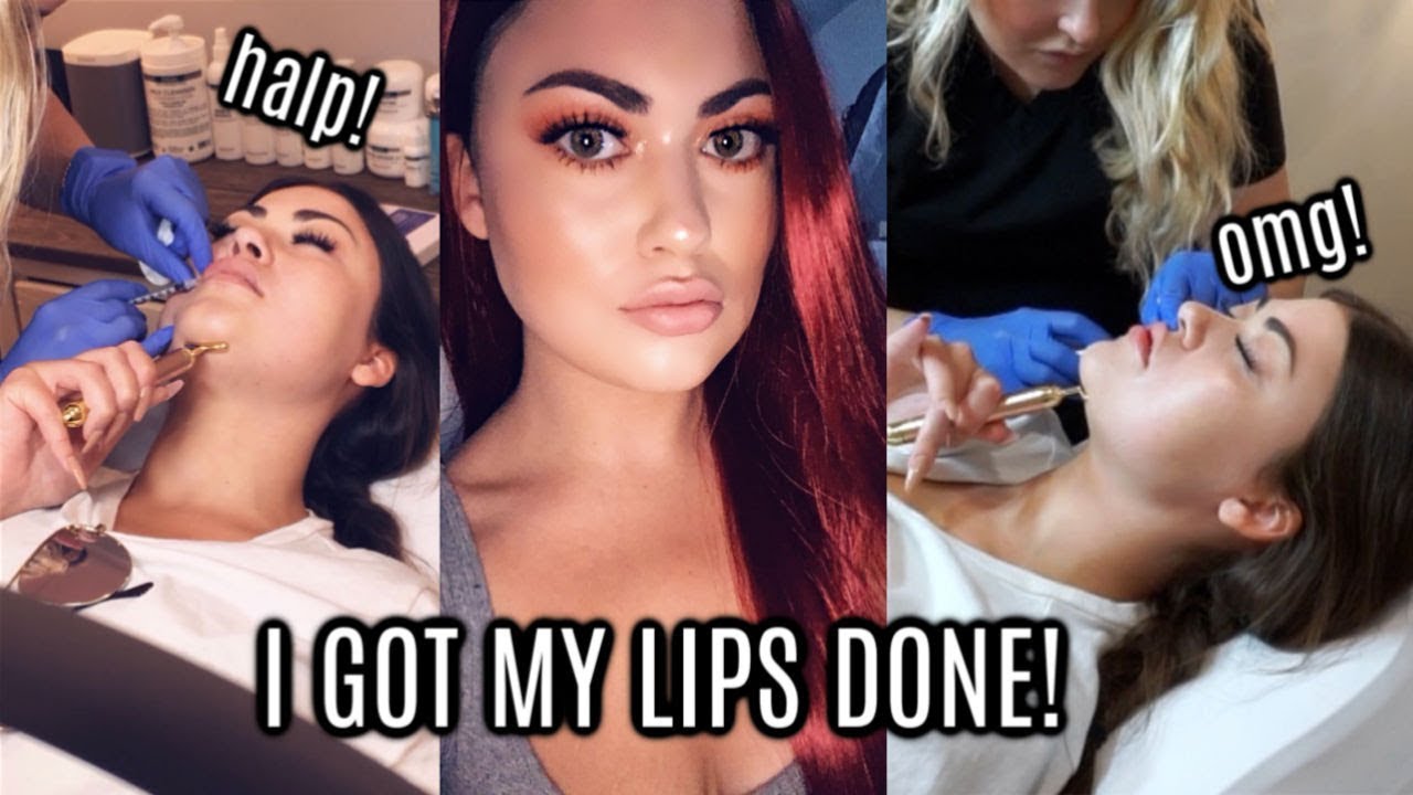 My LIP FILLER Experience! 👄💉
