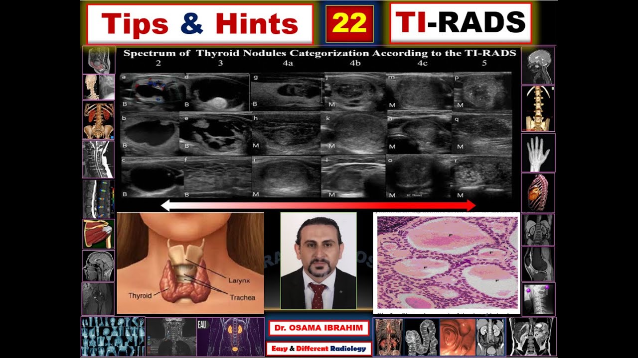 Tips & Hints 22 TI RADS (how to score thyroid nodule)