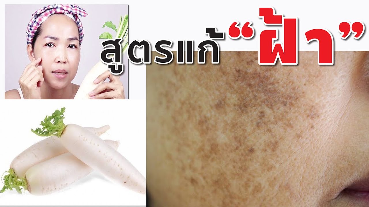 วิธีรักษาฝ้าด้วยหัวไชเท้า แตงกวา น้ำผึ้ง ช่วยให้ฝ้าจางลง | Natural formula to treat melasma