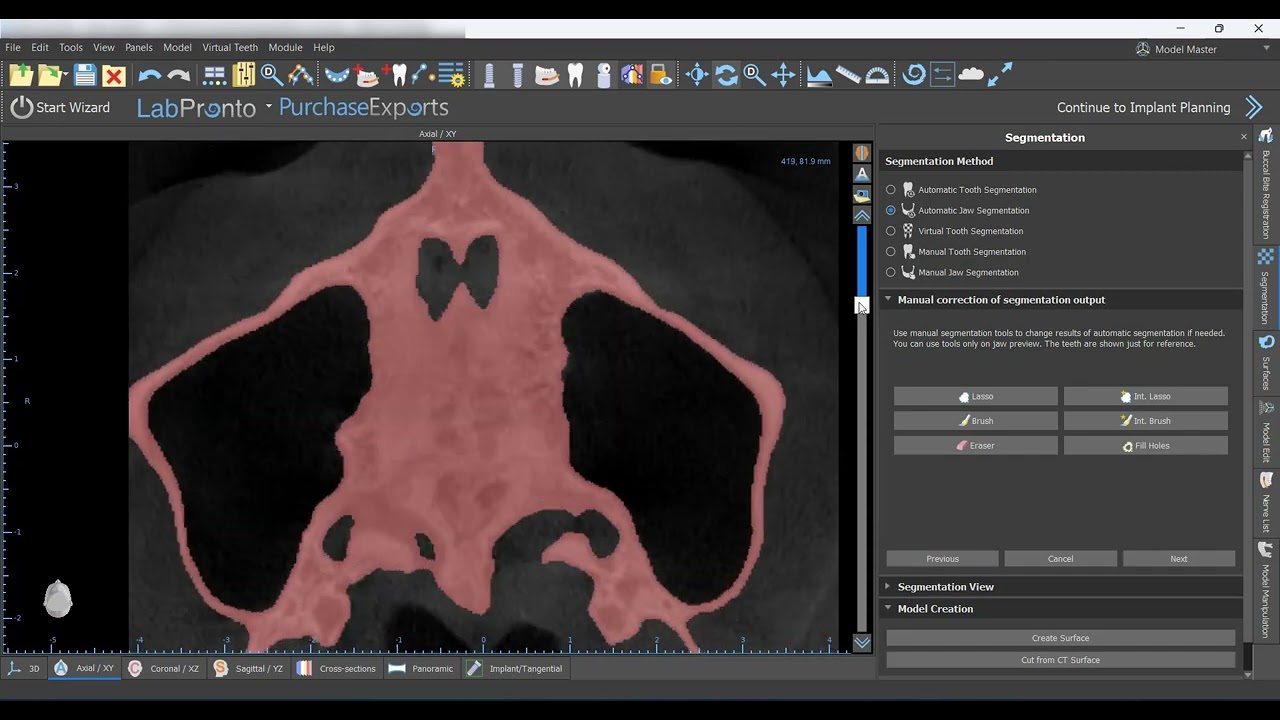 AI Driven Automatic Bone Segmentation in Blue Sky Plan!!!!