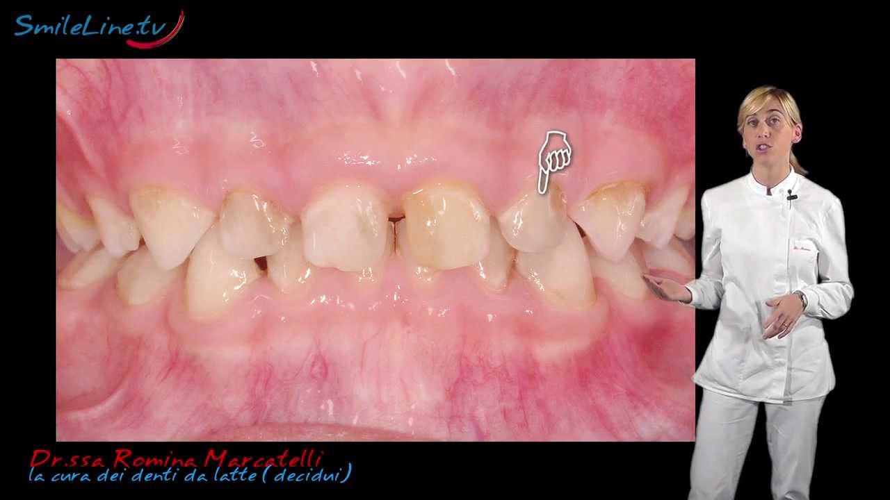 la cura dei denti da latte, bambino con dente cariato - Clinica Merli Rimini