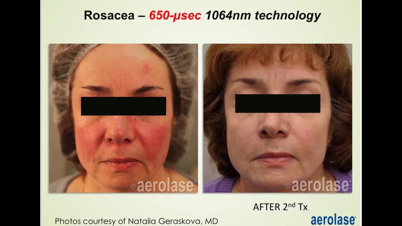 New Laser Therapy for Vascular Conditions with David J. Goldberg, MD, JD