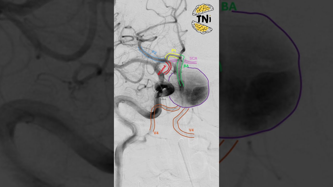 Giant Ruptured Vertebrobasilar Aneurysm