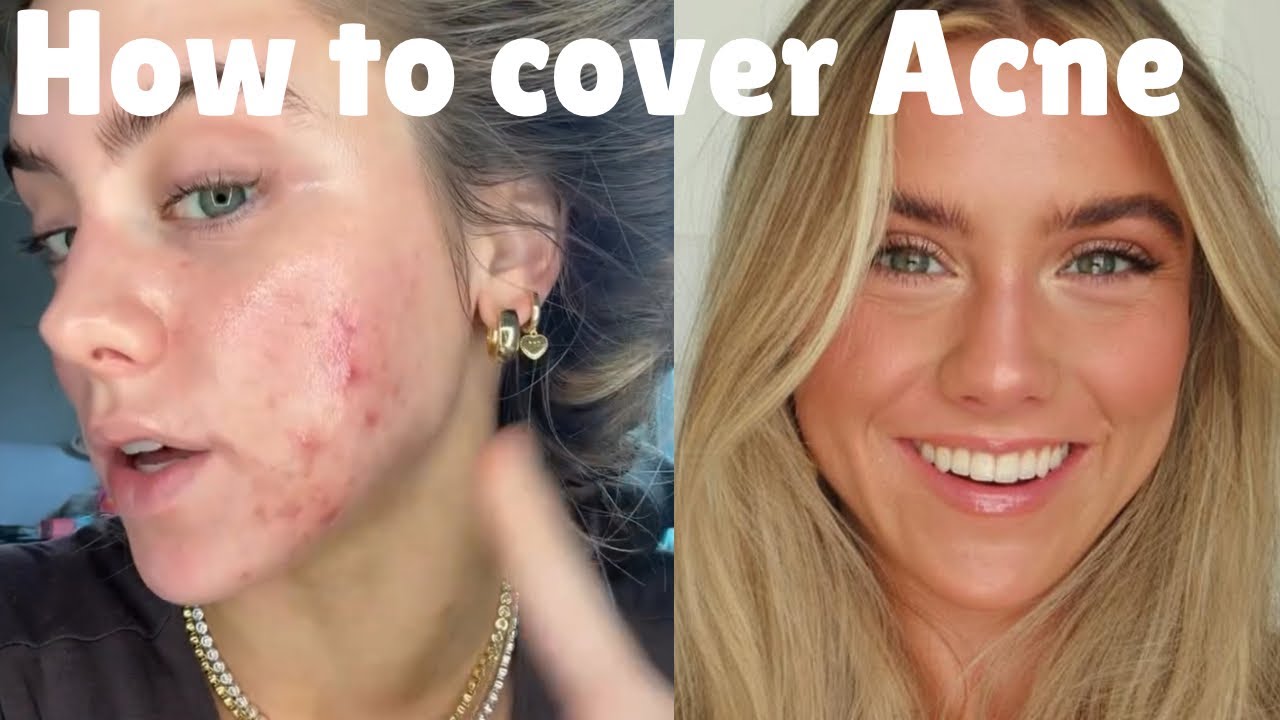 How to cover Acne prone breakout sensitive Skin with Makeup for glowy look ​⁠@FaceLab
