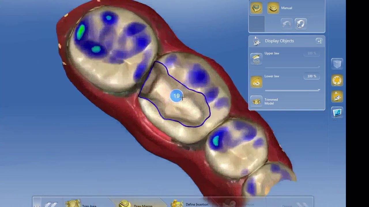 CEREC Inlay/Onlay Design (#19DO)!