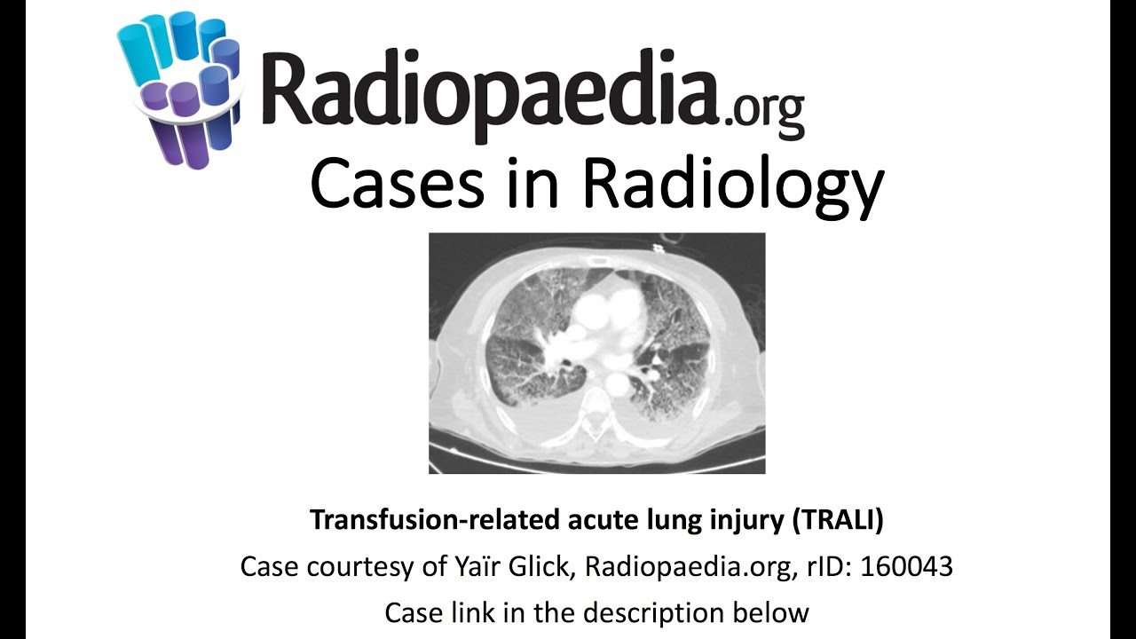 Transfusion-related acute lung injury (TRALI) (Radiopaedia.org) Cases in Radiology
