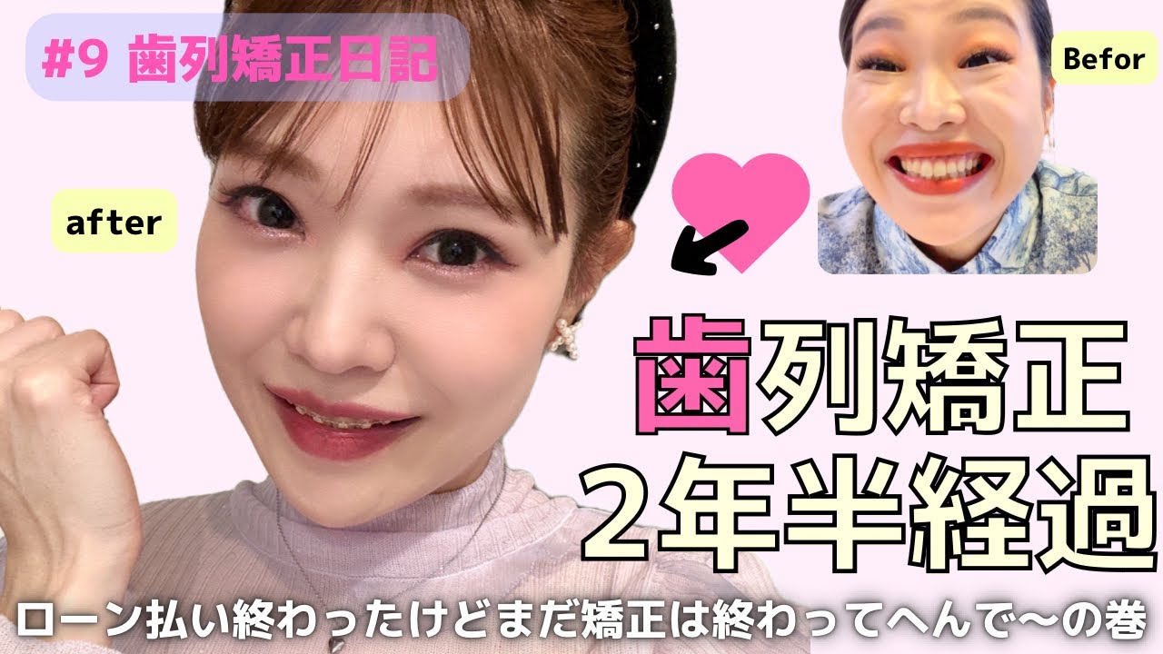 【歯列矯正日記#9】矯正生活2年半突入！矯正治療のお金の話と2年半の経過写真