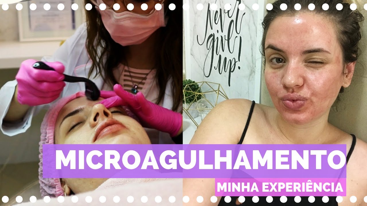 Diário do Microagulhamento - Vida de Mulher | Veda #29