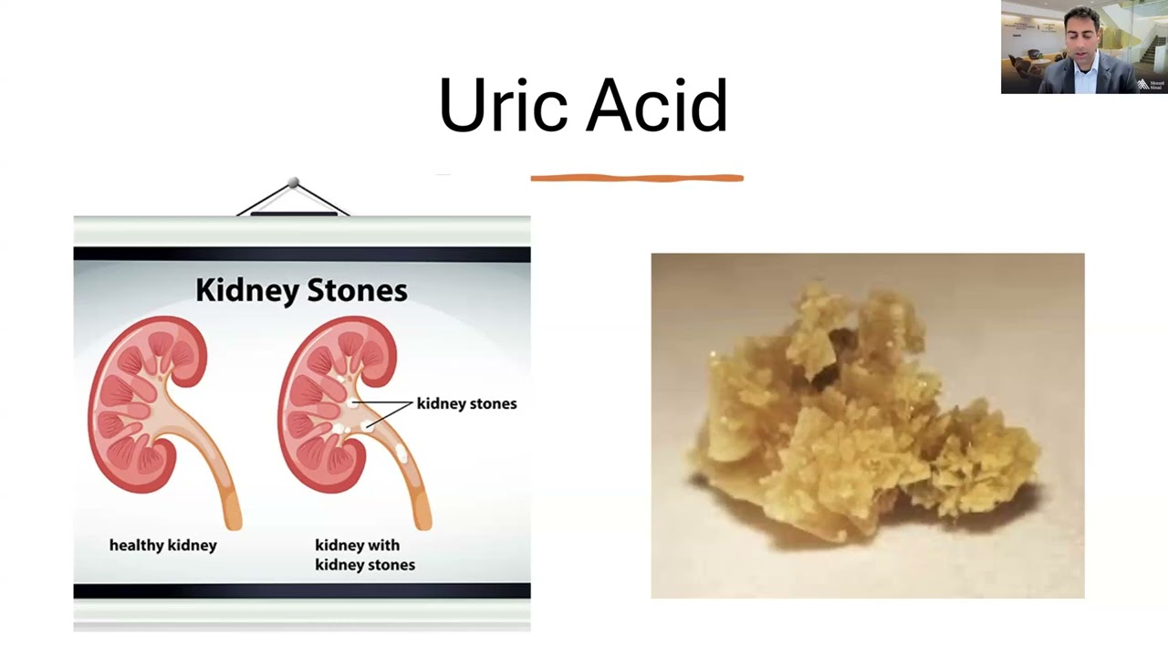 All About Tumor Lysis Syndrome in DLBCL