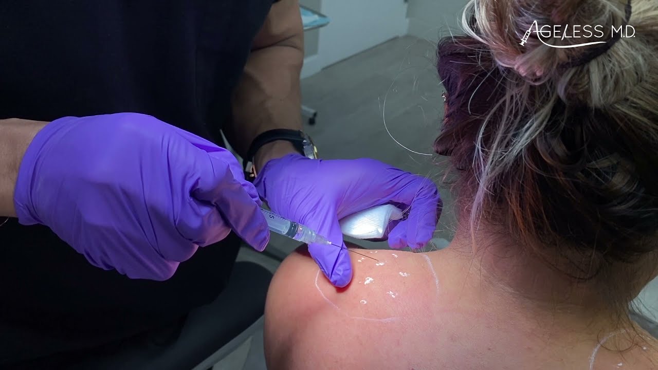 Dysport/Botox trapezius muscles by Dr. Tsay - Ageless MD