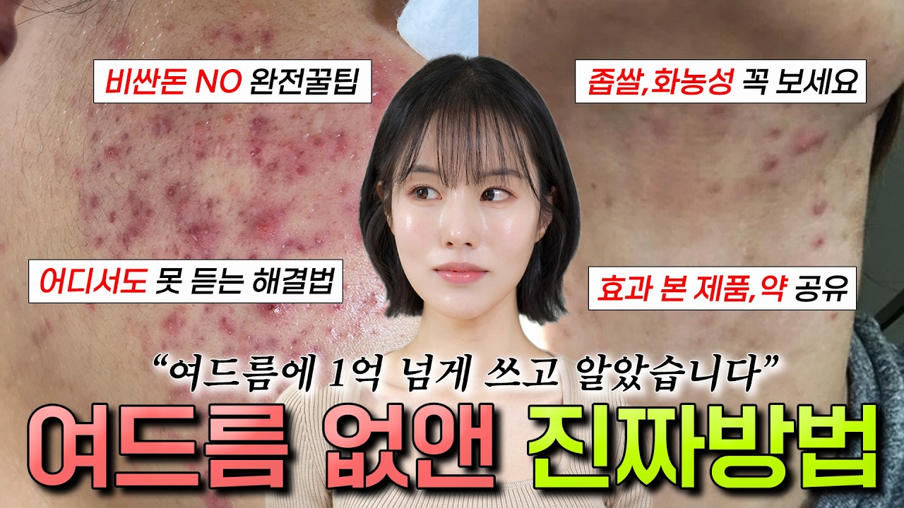 ⭕여드름 없애는 진짜 방법⭕ 딱 이것만 보시면 됩니다! 10년 전에 이걸 알았더라면..😢