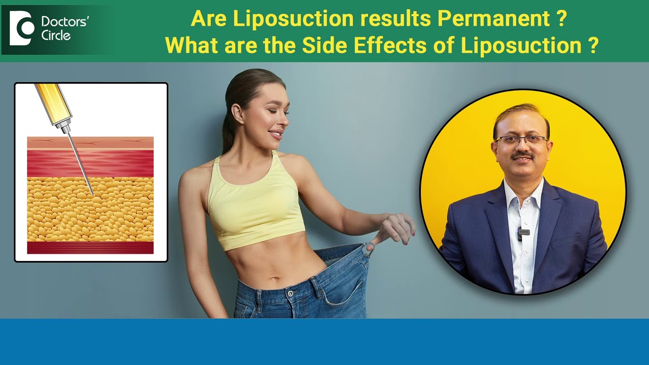 Are LIPOSUCTION results PERMANENT? | Side Effects of Liposuction? - Dr.Girish A C | Doctors' Circle