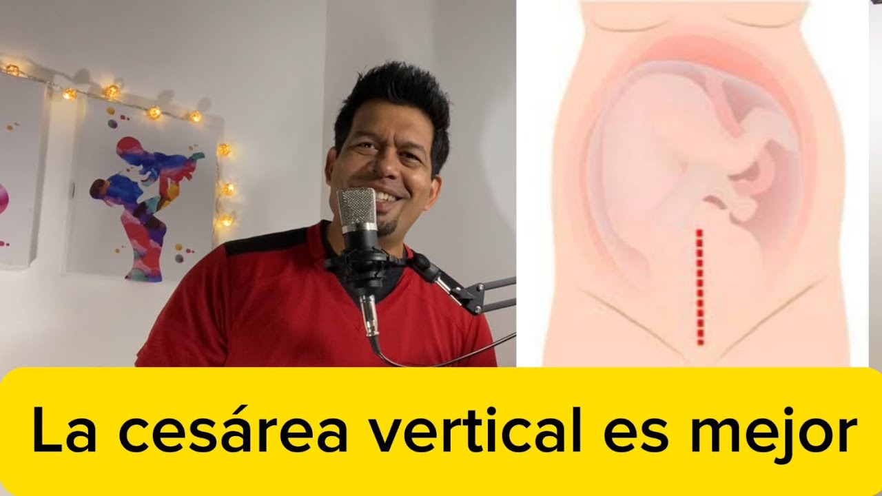 ¿CUÁL CESAREA ES MEJOR, LA VERTICAL O LA DE BIKINI?