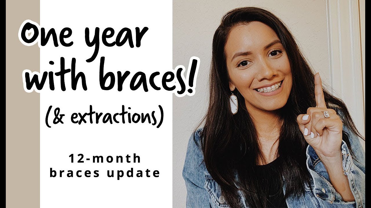 ONE YEAR WITH BRACES (AFTER 4 EXTRACTIONS) + TIME LAPSE | 12-month braces update