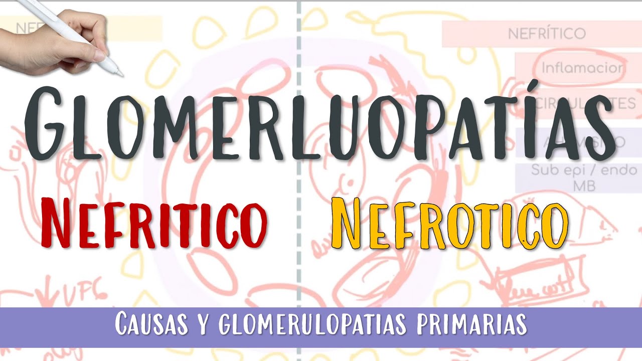 GLOMERULOPATIAS #Nefrotico #Nefritico #GNRP #Membranosa #GNPE  #FocalySegmentaria #Glomerulonefritis