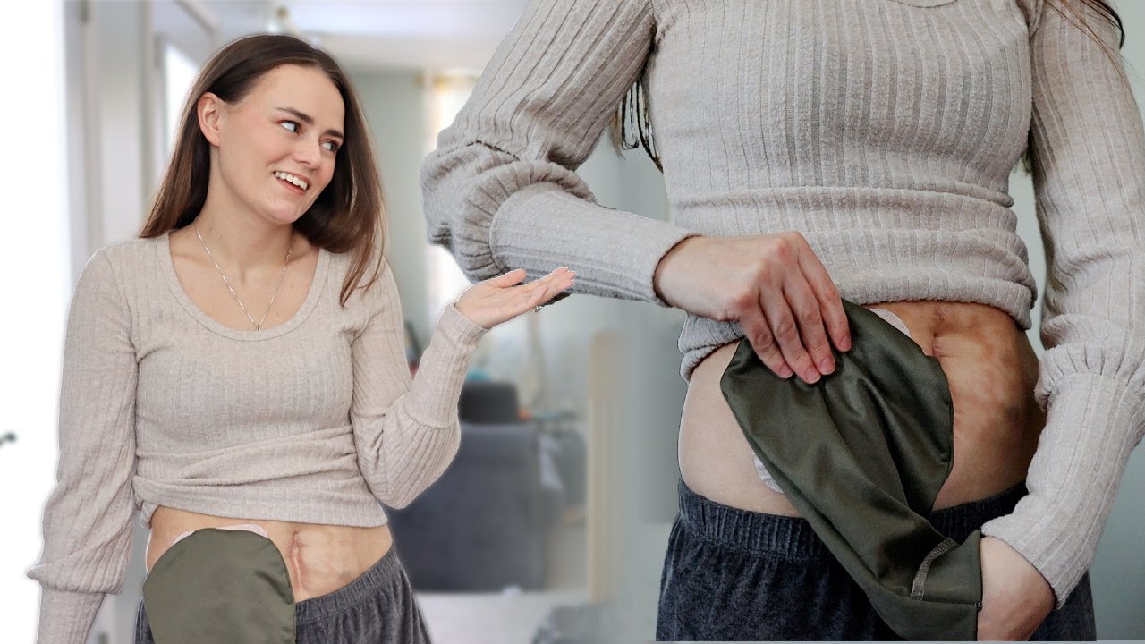 My Ostomy Would Leak Everyday & I Wish I Had This! | StomaCloak's NODOR Review | Let's Talk IBD