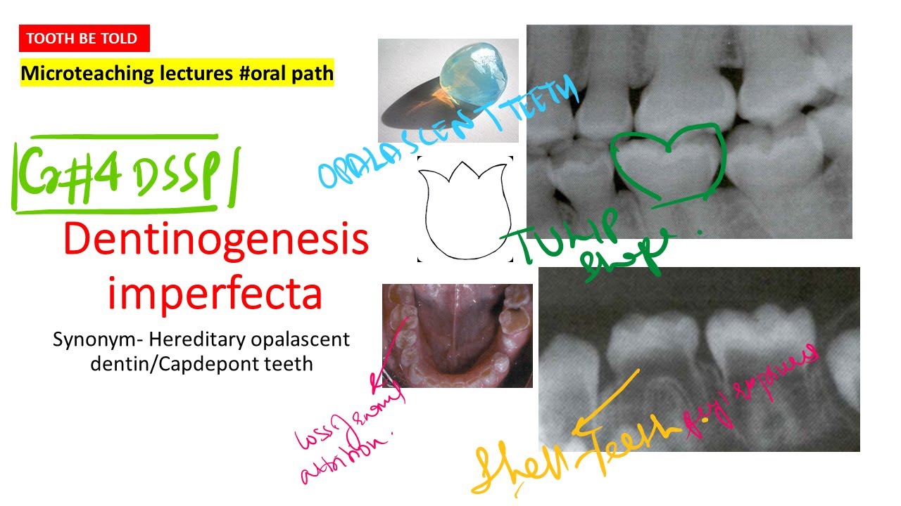 Dentinogenesis Imperfecta | Type 1 and 2 |High yield points with diagrams|NEET MDS | INI-CET | INBDE