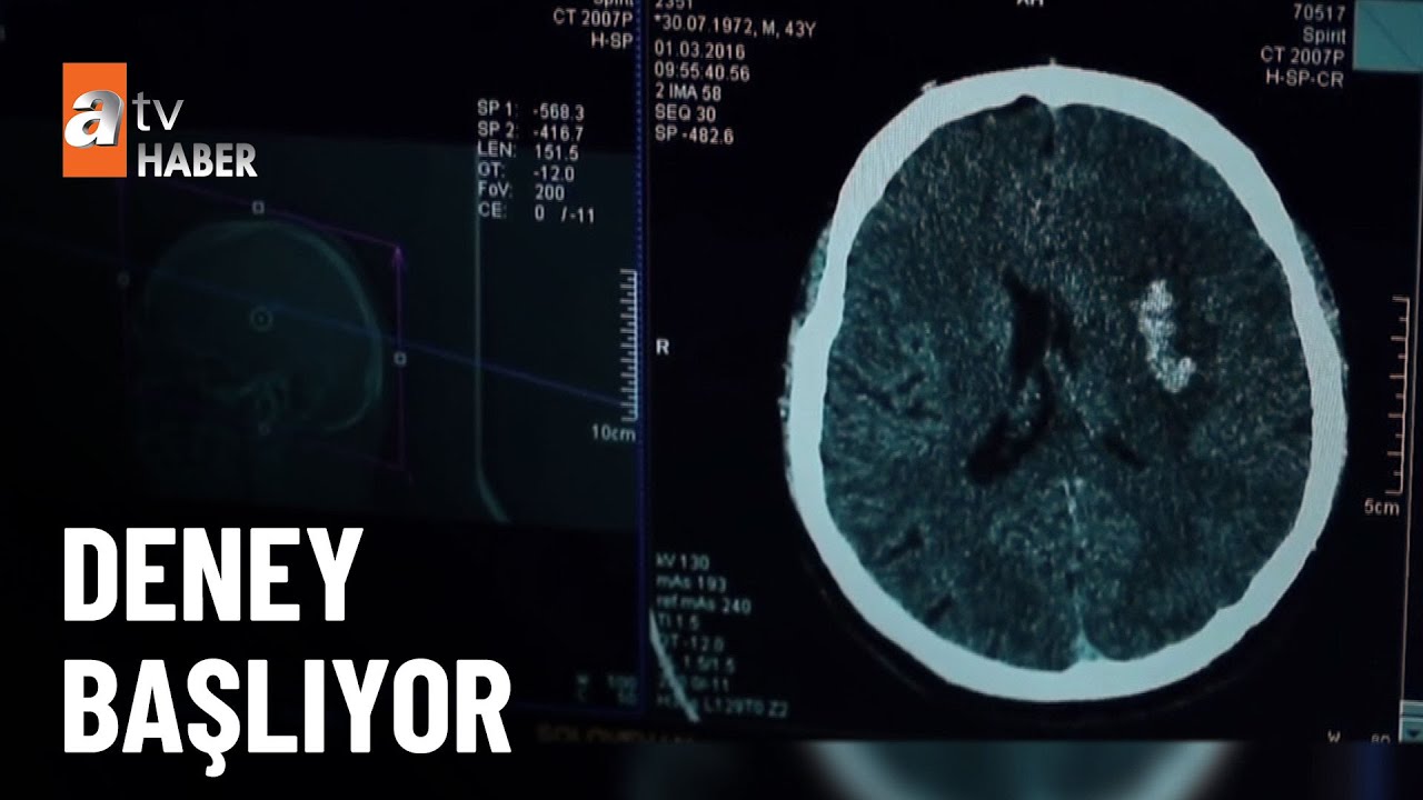 Onarıcı beyin çipi geliyor - atv Ana Haber 20 Eylül 2023