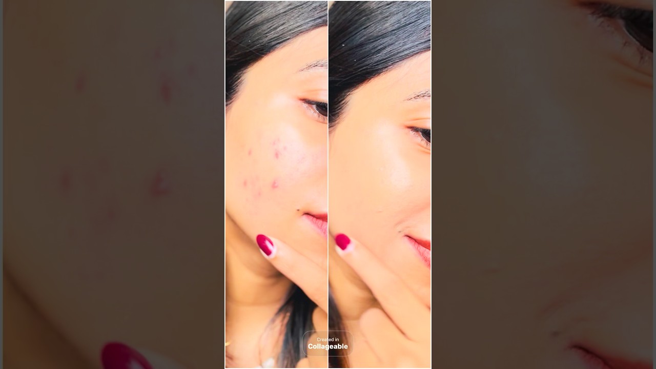 Watch My Acne Marks Disappear in Seconds 😳 