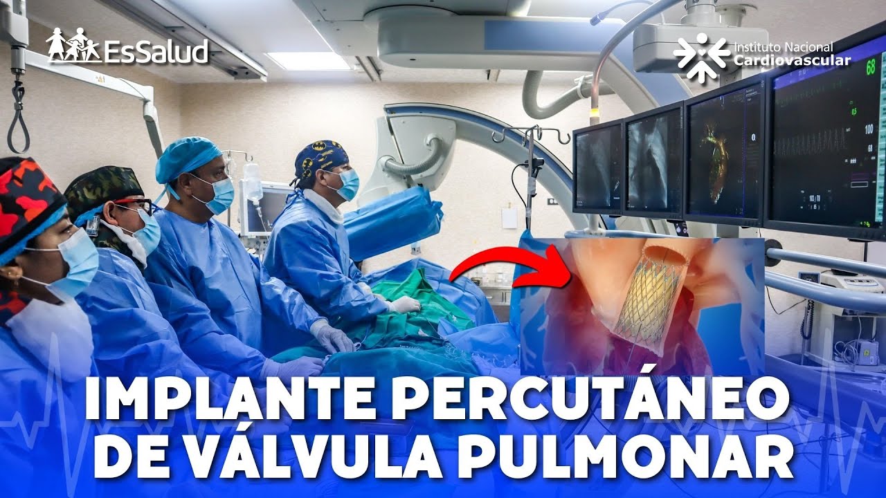 Implante de Válvula Pulmonar en paciente pediátricos - INCOR
