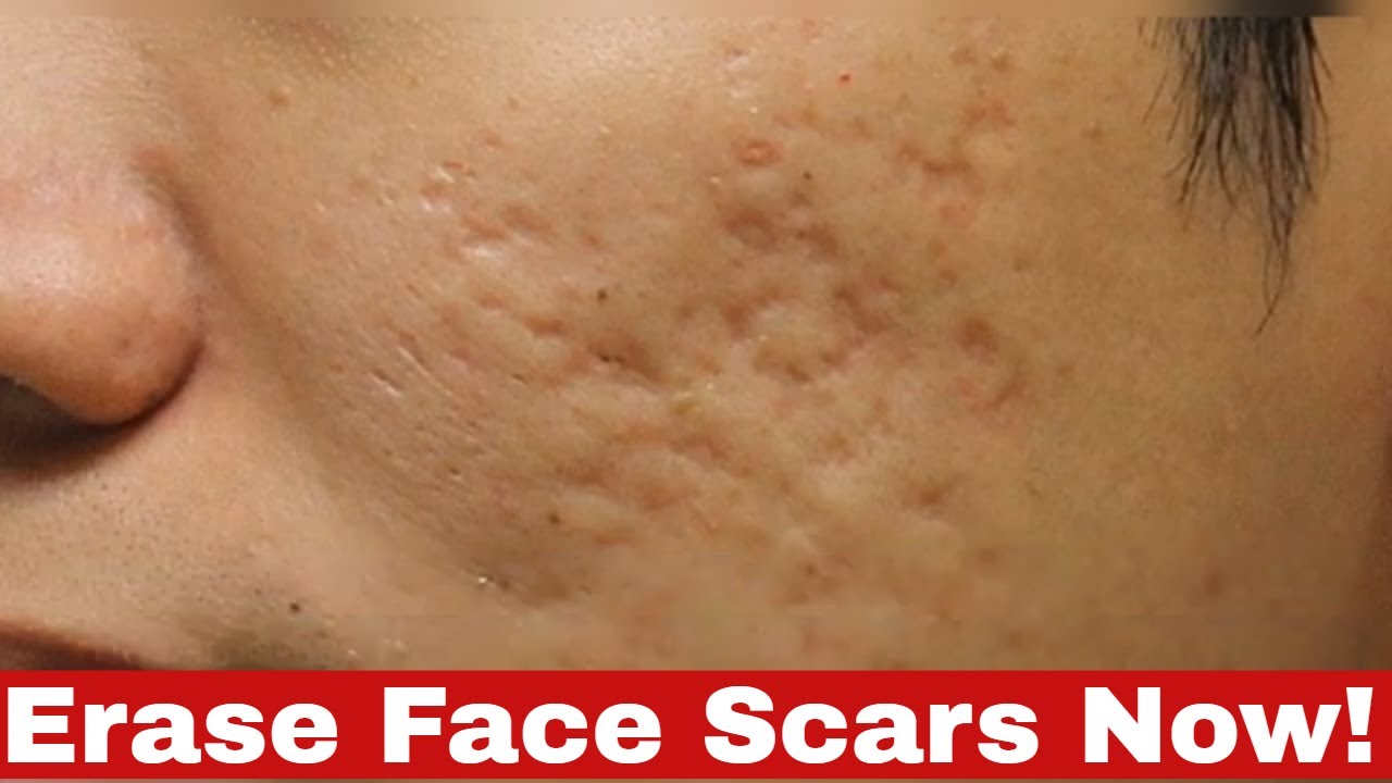 Proven Ways on How to Get Rid of Scars on Face: A Must Watch!