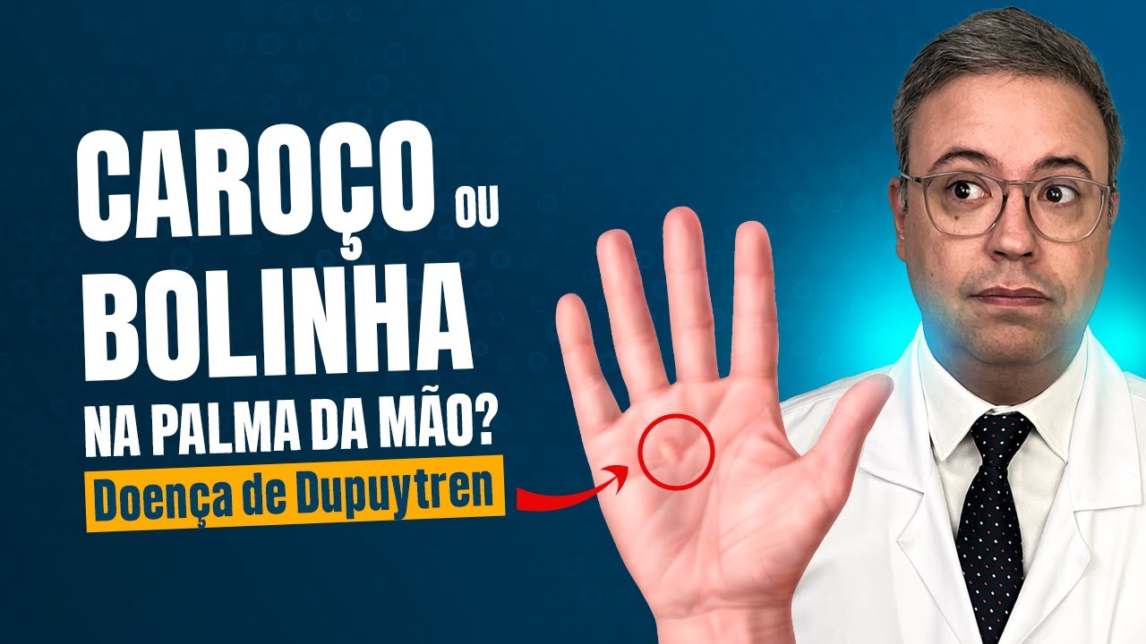 Carocinho  bolinha na palma da mão | Doença de Dupuytren