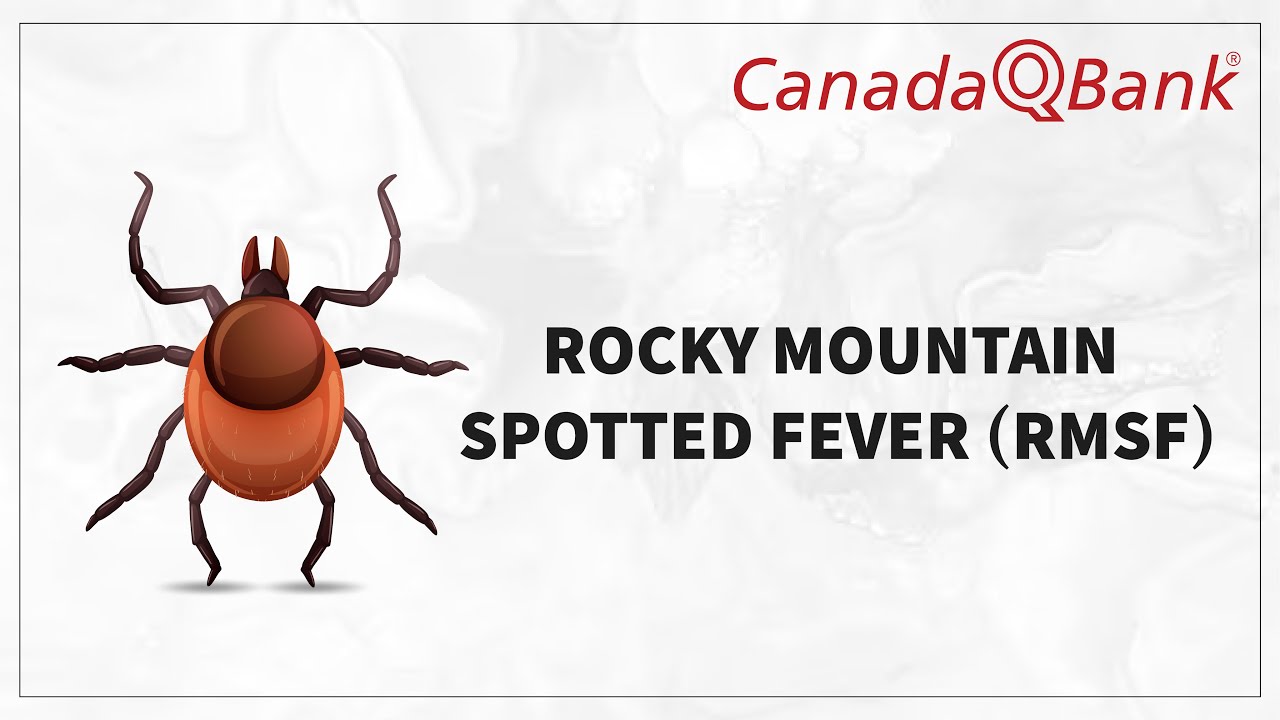 Rocky Mountain Spotted Fever (RMSF): Symptoms, Diagnosis & Treatment | Clinical Vignettes