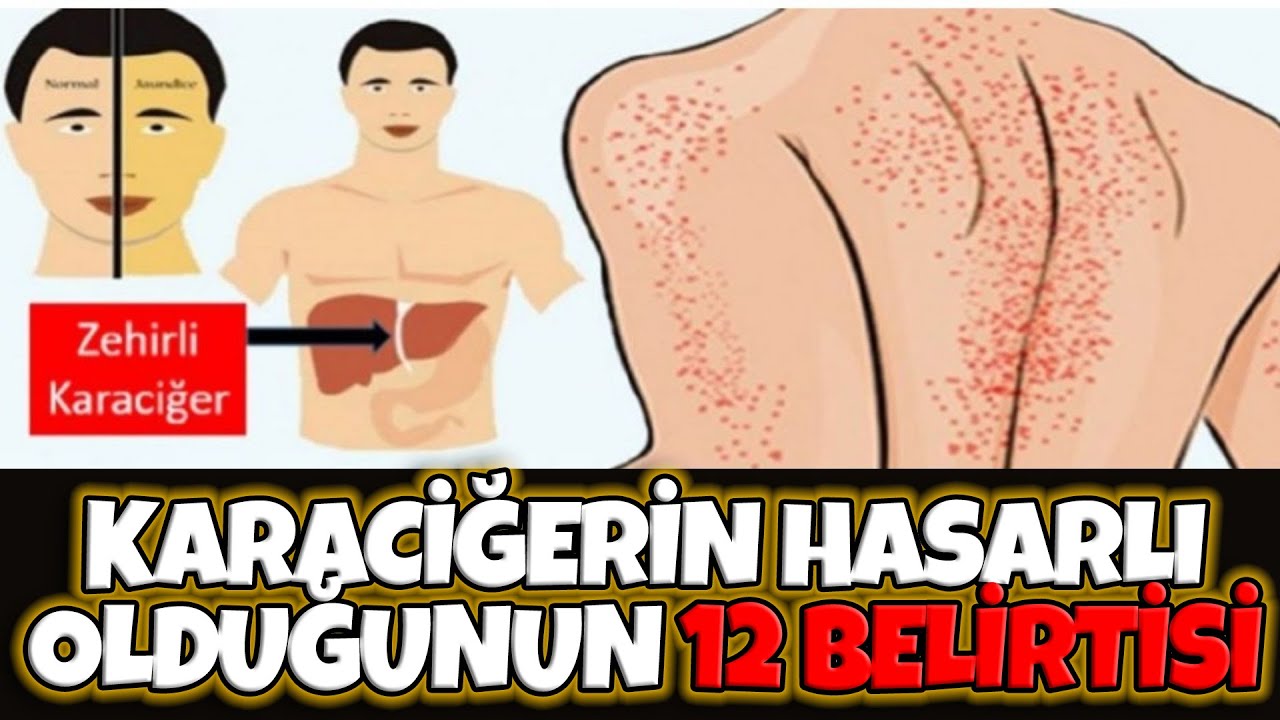 12 Belirti Karaciğerinizde Sorun Olduğunu Gösterir!