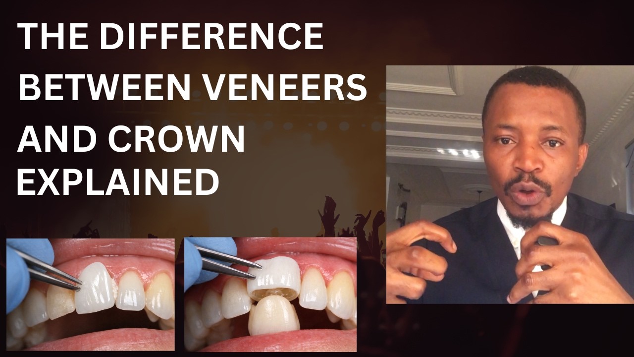 Dental crown Vs veneers: Watch the clear difference! (Well explained)