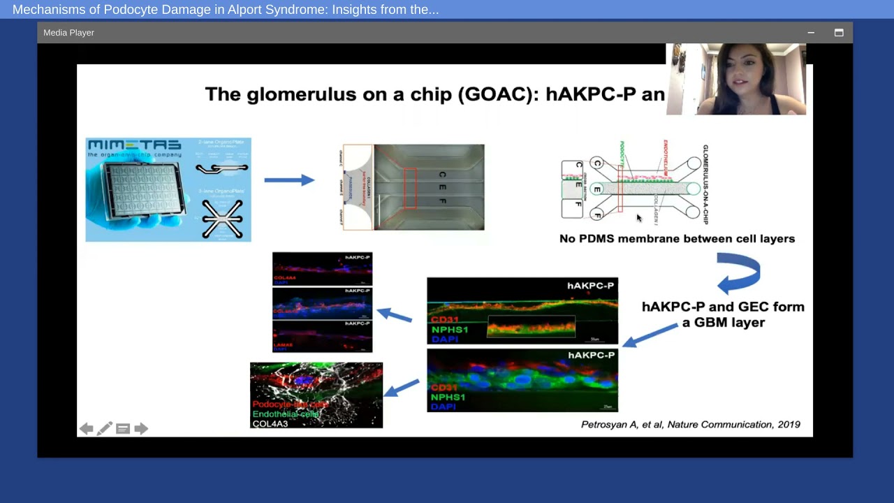 Mechanisms of Podocyte Damage in Alport Syndrome: Insights from the Alport-on-a-chip System