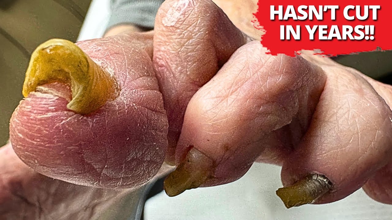Эти ногти на ногах не стригли ГОДАМИ 😱 | Стрижка очень толстых ногтей
