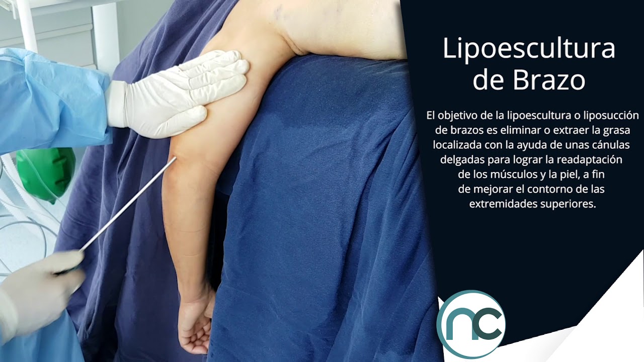 Dr. Nelson Chaves - Lipoescultura de Brazo