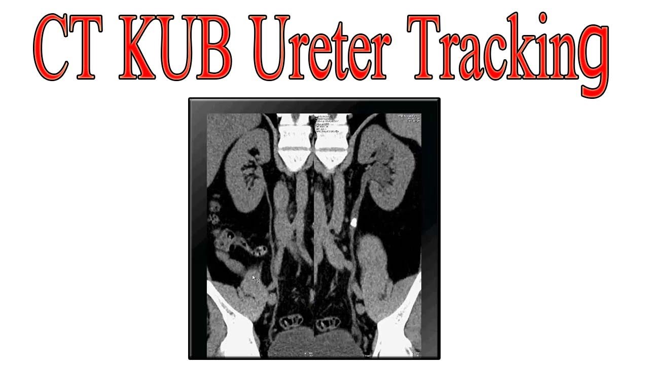 CT KUB Ureter tracking filming