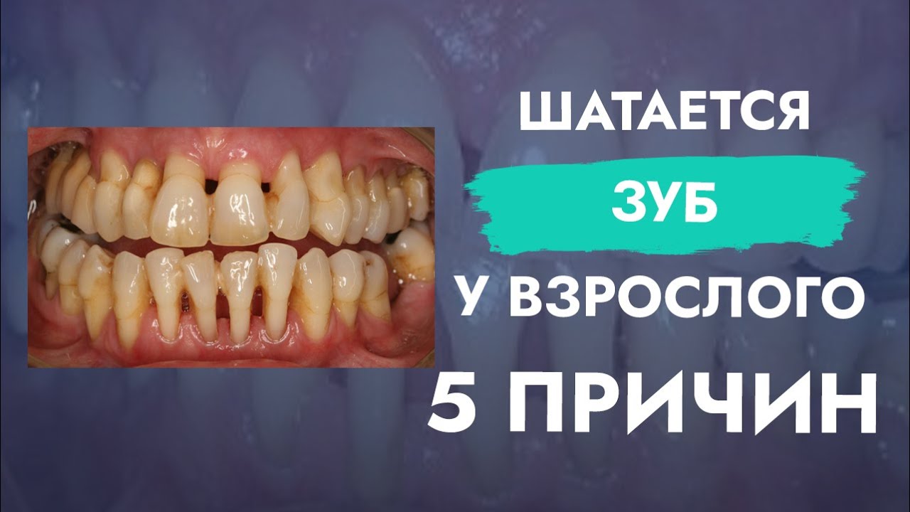 Шатается зуб у взрослого. 5 причин