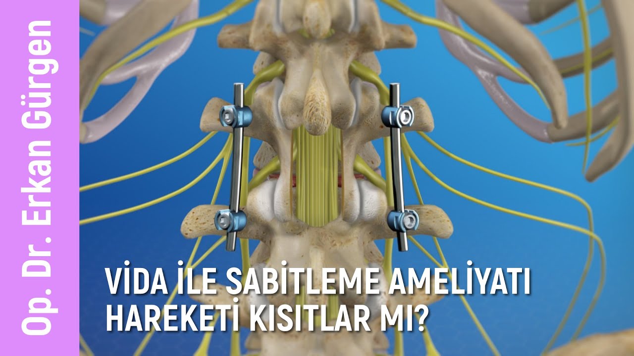 Vida ile sabitleme ameliyatları hareketleri kısıtlar mı?