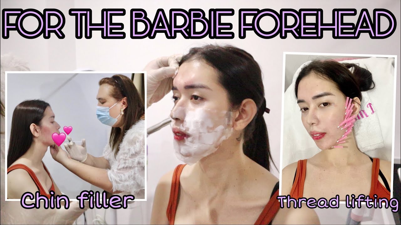 BARBIE FOREHEAD + CHIN AUGMENTATION + THREAD LIFTING + BOTOX BUUUGSH (PART 1) || VLOG#146 JanaLarman