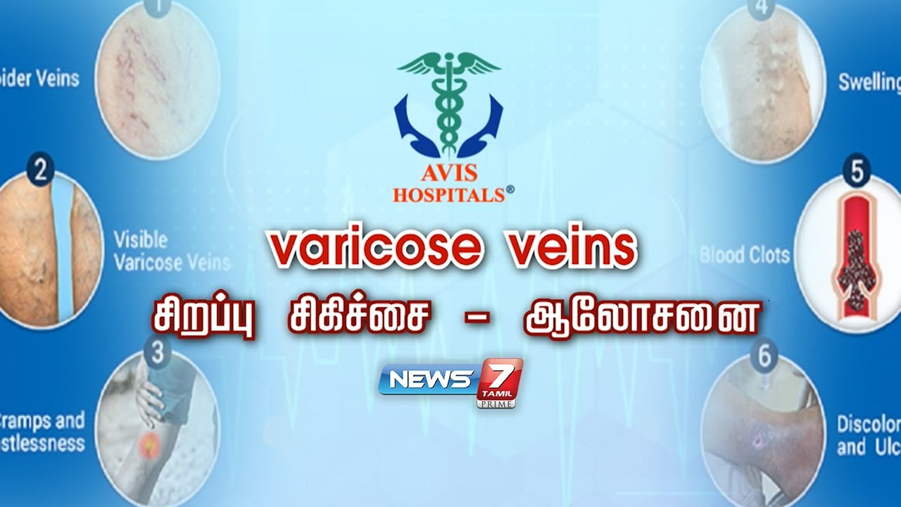வெரிகோஸ் வெயின் என்றால் என்ன? | Vericose veins | Avishospitals | 17.09.21