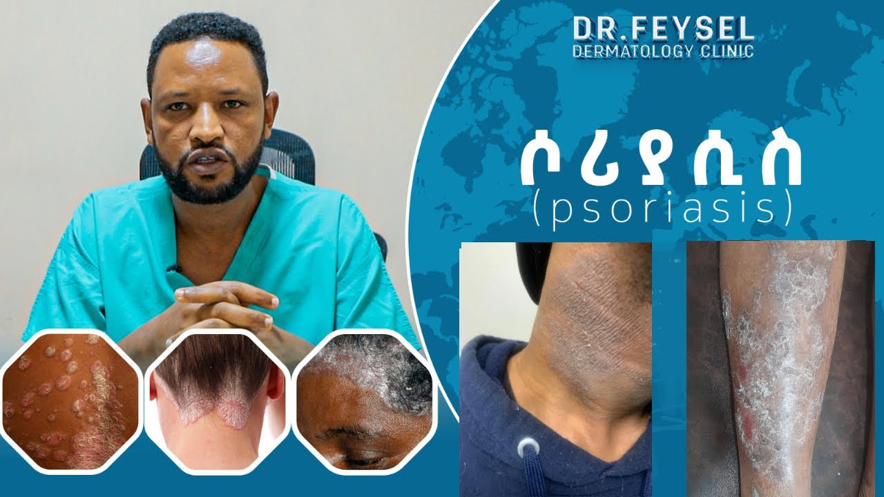 ሶሪያሲስ ምንድነው? Psoriasis Dr. Feysel