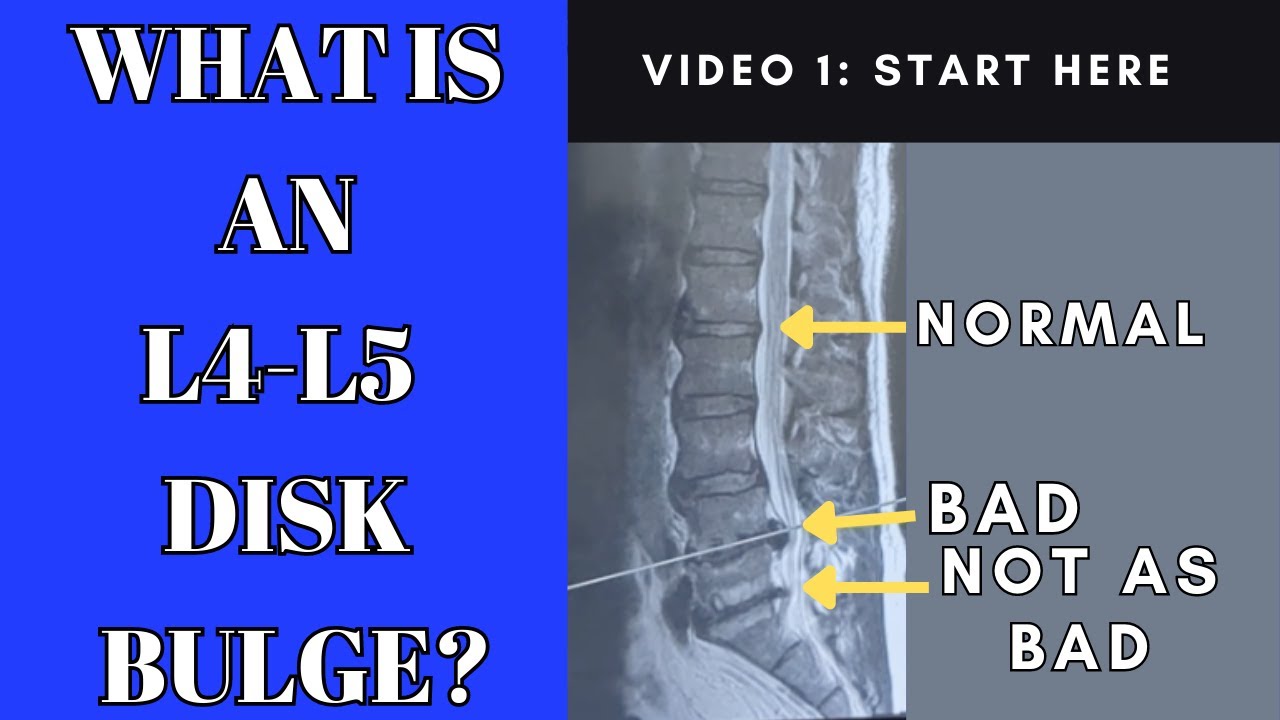What Is An L4-L5 Disc Bulge And Why It Hurts So Much  | Dr Gregory Kramer Chiropractor in Livonia MI