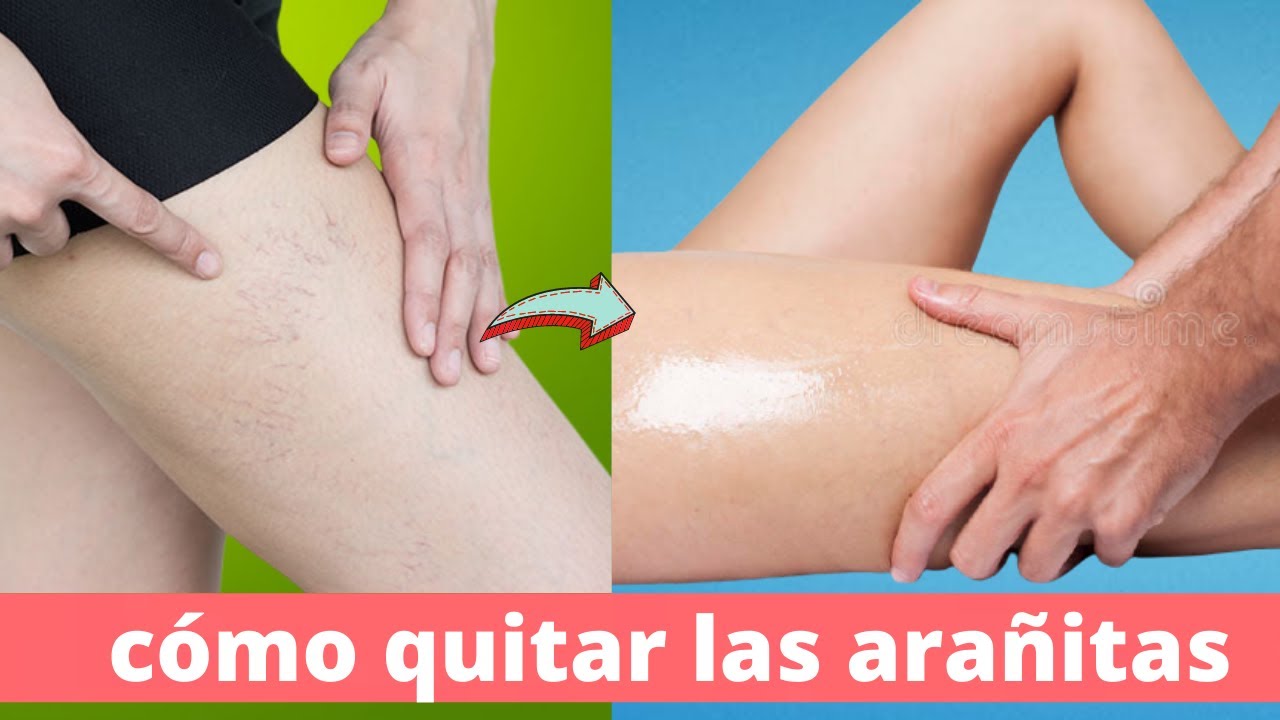 Cómo quitar las arañitas en las piernas con 5 ejercicios