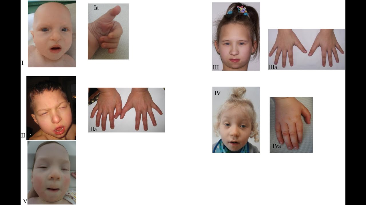 Ohdo Syndrome Or Say-Barber-Biesecker-Young-Simpson (SBBYS) variant ; Definition, Causes,Treatment
